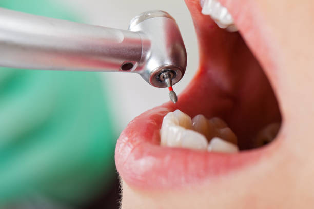Best Lost Filling or Crown Replacement in Angwin, CA